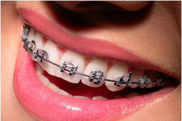 Metal_braces