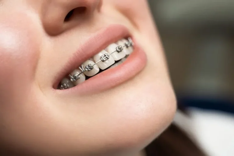 Types-of-Braces_1648491073.jpg.optimal